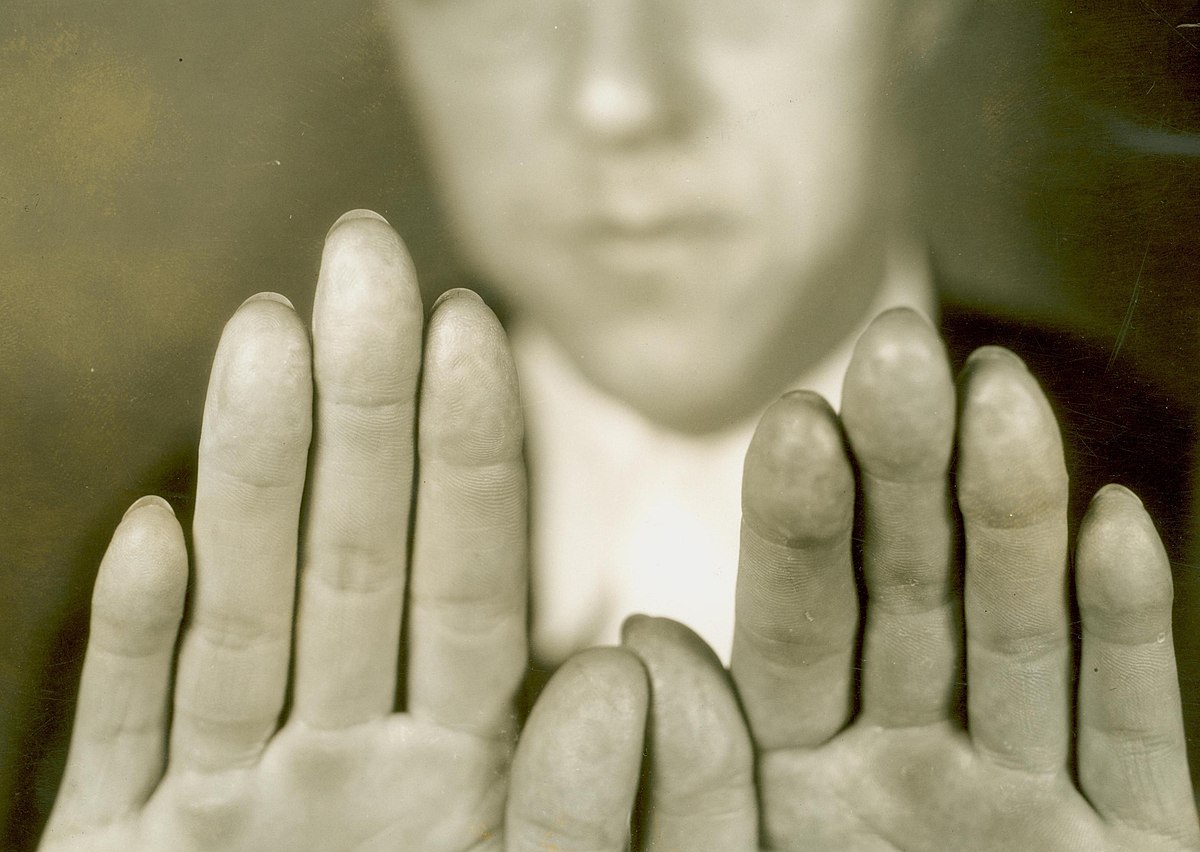 Karpis had his fingerprints removed in 1934